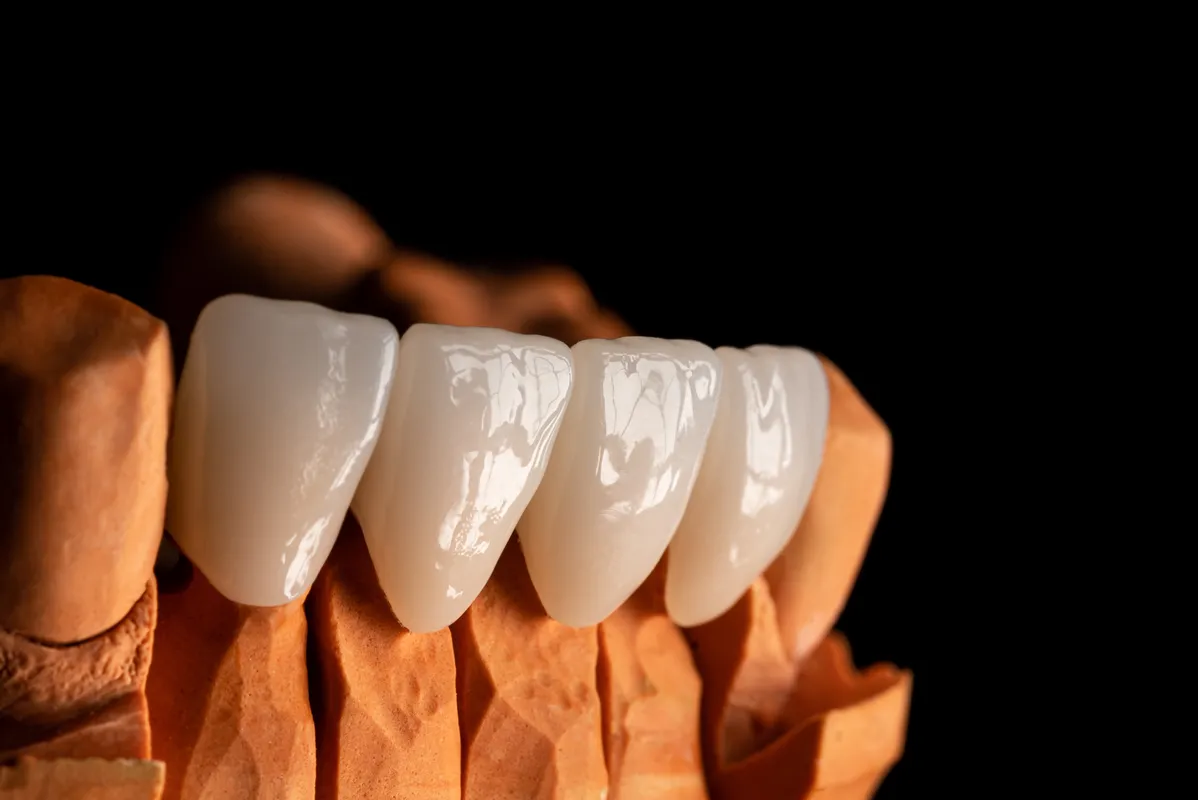 Lucrări Fixe - dentalbit dental bit tg mureș laborator tehnică dentară laborator tehnica dentara tg mures mures fogtechnikus marosvasarhely fogtechnia CAD/CAM exocad digital Laborator Tehnică Dentară Proiectare Digitală Dentară Lucrări Fixe Lucrări Fixe Pe Implant Lucrări Mobile Lucrări Mobilizabile tehnică dentară digitală