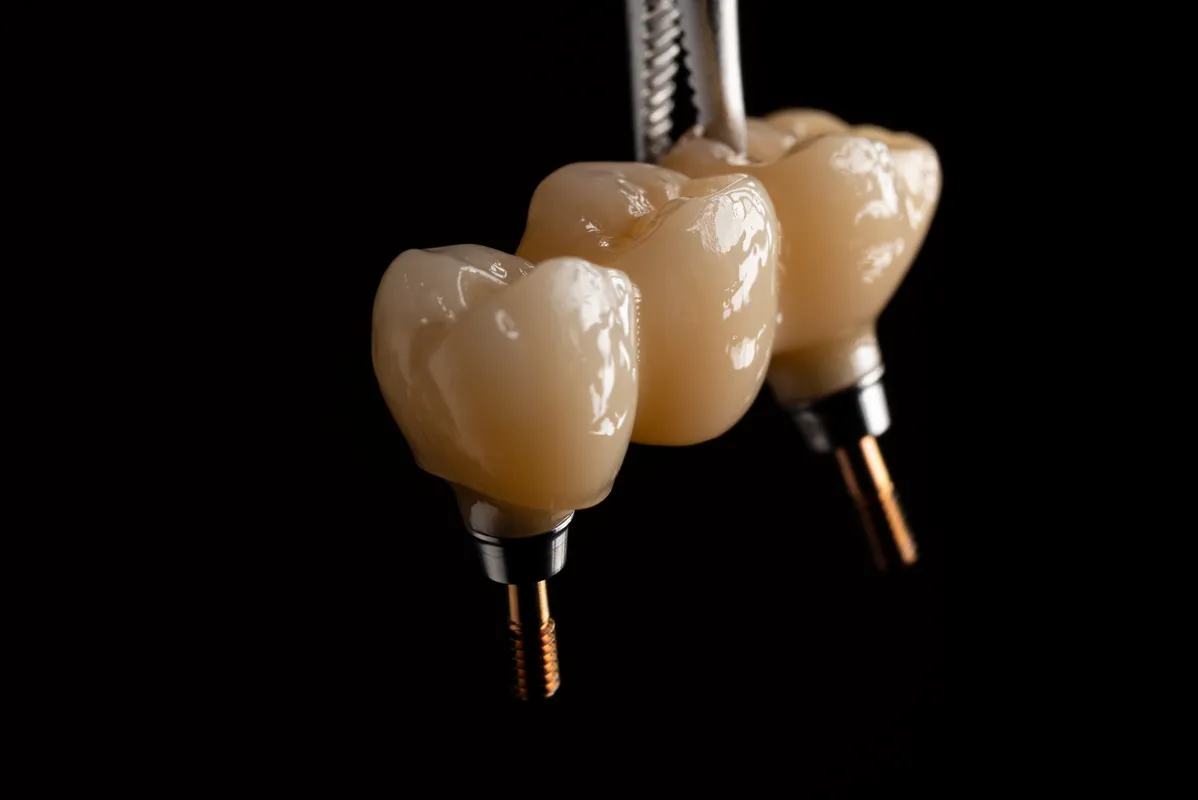 Lucrări Fixe pe Implant - dentalbit dental bit tg mureș laborator tehnică dentară laborator tehnica dentara tg mures mures fogtechnikus marosvasarhely fogtechnia CAD/CAM exocad digital Laborator Tehnică Dentară Proiectare Digitală Dentară Lucrări Fixe Lucrări Fixe Pe Implant Lucrări Mobile Lucrări Mobilizabile tehnică dentară digitală