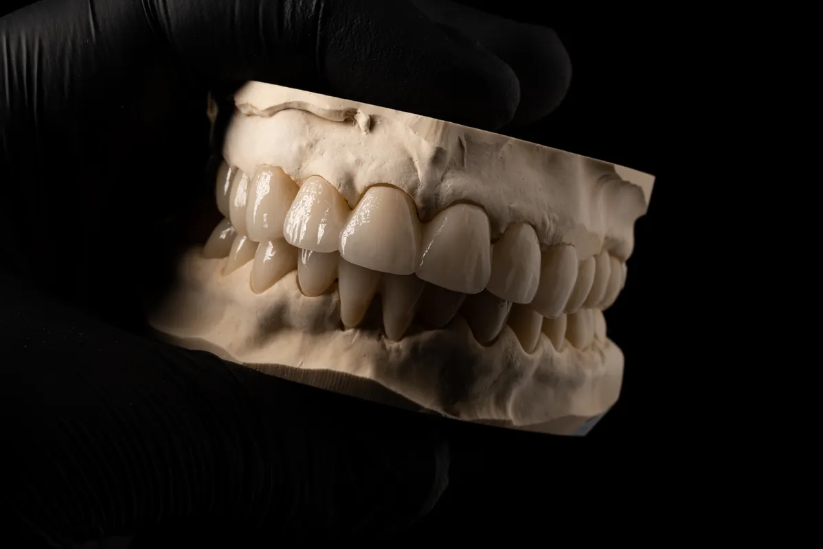 Lucrări Fixe - dentalbit dental bit tg mureș laborator tehnică dentară laborator tehnica dentara tg mures mures fogtechnikus marosvasarhely fogtechnia CAD/CAM exocad digital Laborator Tehnică Dentară Proiectare Digitală Dentară Lucrări Fixe Lucrări Fixe Pe Implant Lucrări Mobile Lucrări Mobilizabile tehnică dentară digitală