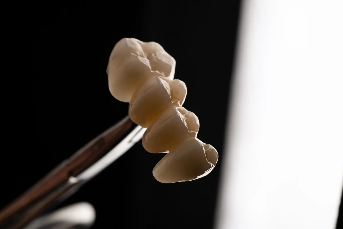 Lucrări Fixe - dentalbit dental bit tg mureș laborator tehnică dentară laborator tehnica dentara tg mures mures fogtechnikus marosvasarhely fogtechnia CAD/CAM exocad digital Laborator Tehnică Dentară Proiectare Digitală Dentară Lucrări Fixe Lucrări Fixe Pe Implant Lucrări Mobile Lucrări Mobilizabile tehnică dentară digitală