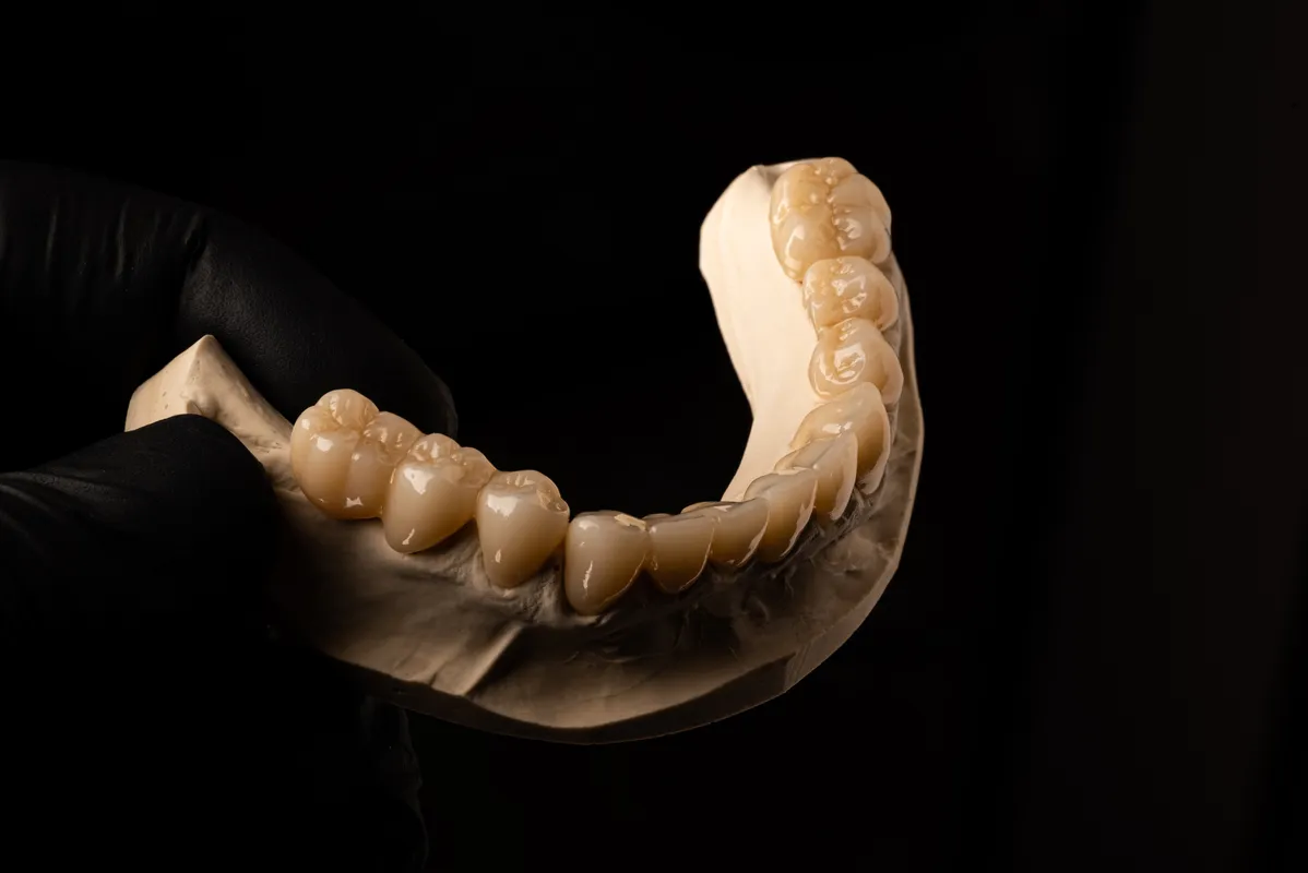 Lucrări Fixe - dentalbit dental bit tg mureș laborator tehnică dentară laborator tehnica dentara tg mures mures fogtechnikus marosvasarhely fogtechnia CAD/CAM exocad digital Laborator Tehnică Dentară Proiectare Digitală Dentară Lucrări Fixe Lucrări Fixe Pe Implant Lucrări Mobile Lucrări Mobilizabile tehnică dentară digitală