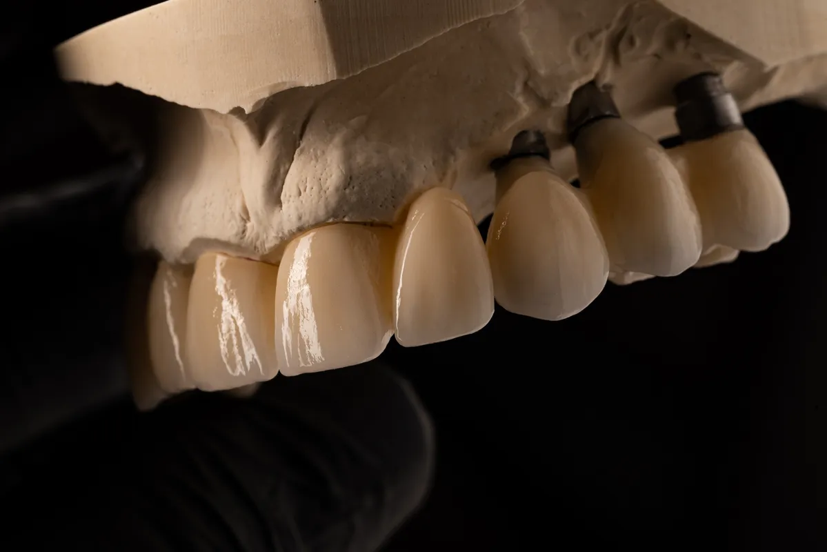 Lucrări Fixe - dentalbit dental bit tg mureș laborator tehnică dentară laborator tehnica dentara tg mures mures fogtechnikus marosvasarhely fogtechnia CAD/CAM exocad digital Laborator Tehnică Dentară Proiectare Digitală Dentară Lucrări Fixe Lucrări Fixe Pe Implant Lucrări Mobile Lucrări Mobilizabile tehnică dentară digitală