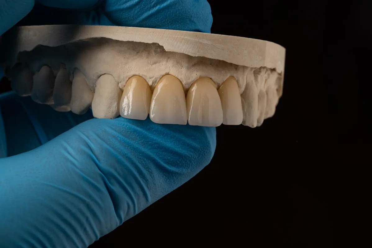 Lucrări Fixe - dentalbit dental bit tg mureș laborator tehnică dentară laborator tehnica dentara tg mures mures fogtechnikus marosvasarhely fogtechnia CAD/CAM exocad digital Laborator Tehnică Dentară Proiectare Digitală Dentară Lucrări Fixe Lucrări Fixe Pe Implant Lucrări Mobile Lucrări Mobilizabile tehnică dentară digitală